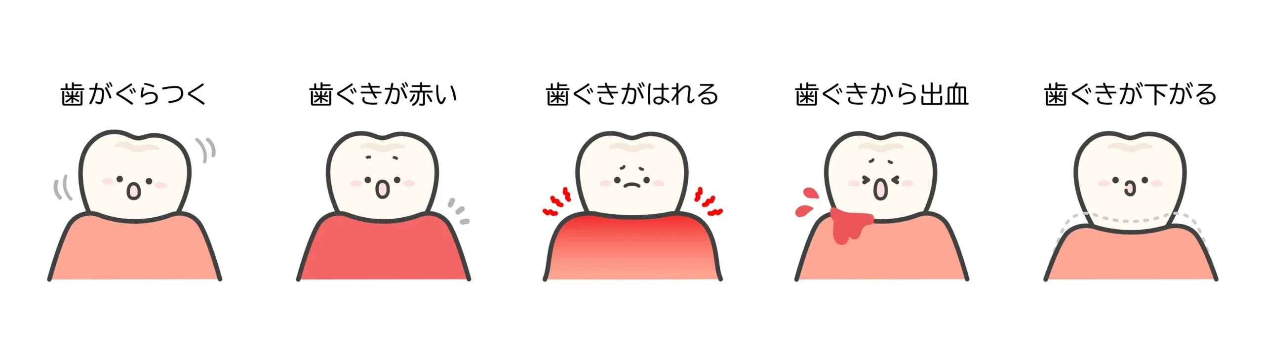 歯周病の症状